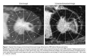 図４　LGE深達度による心筋Viability評価の解析例　　 文献[4]　より引用